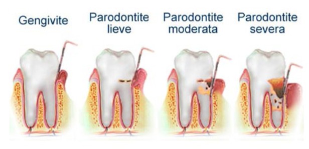gengivite e parodontide